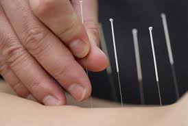 acupuncturepic